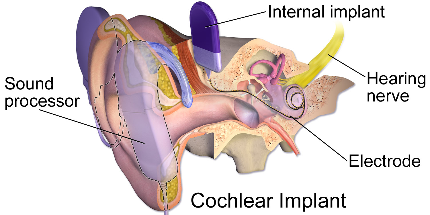 Cochlear_Implant